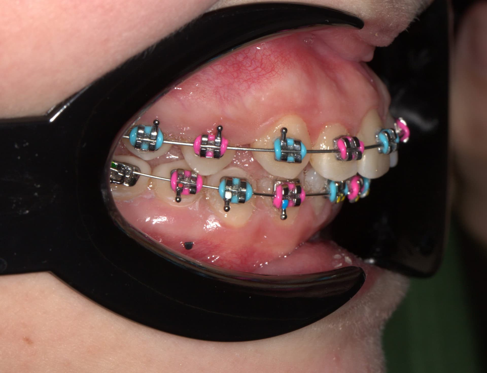 Фиксация брекет системы