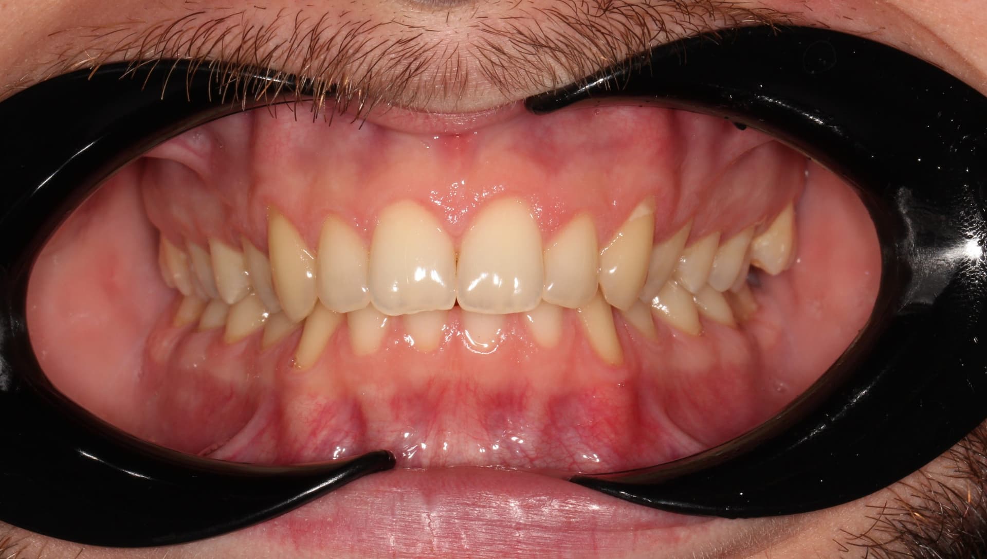 До фиксации брекет системой