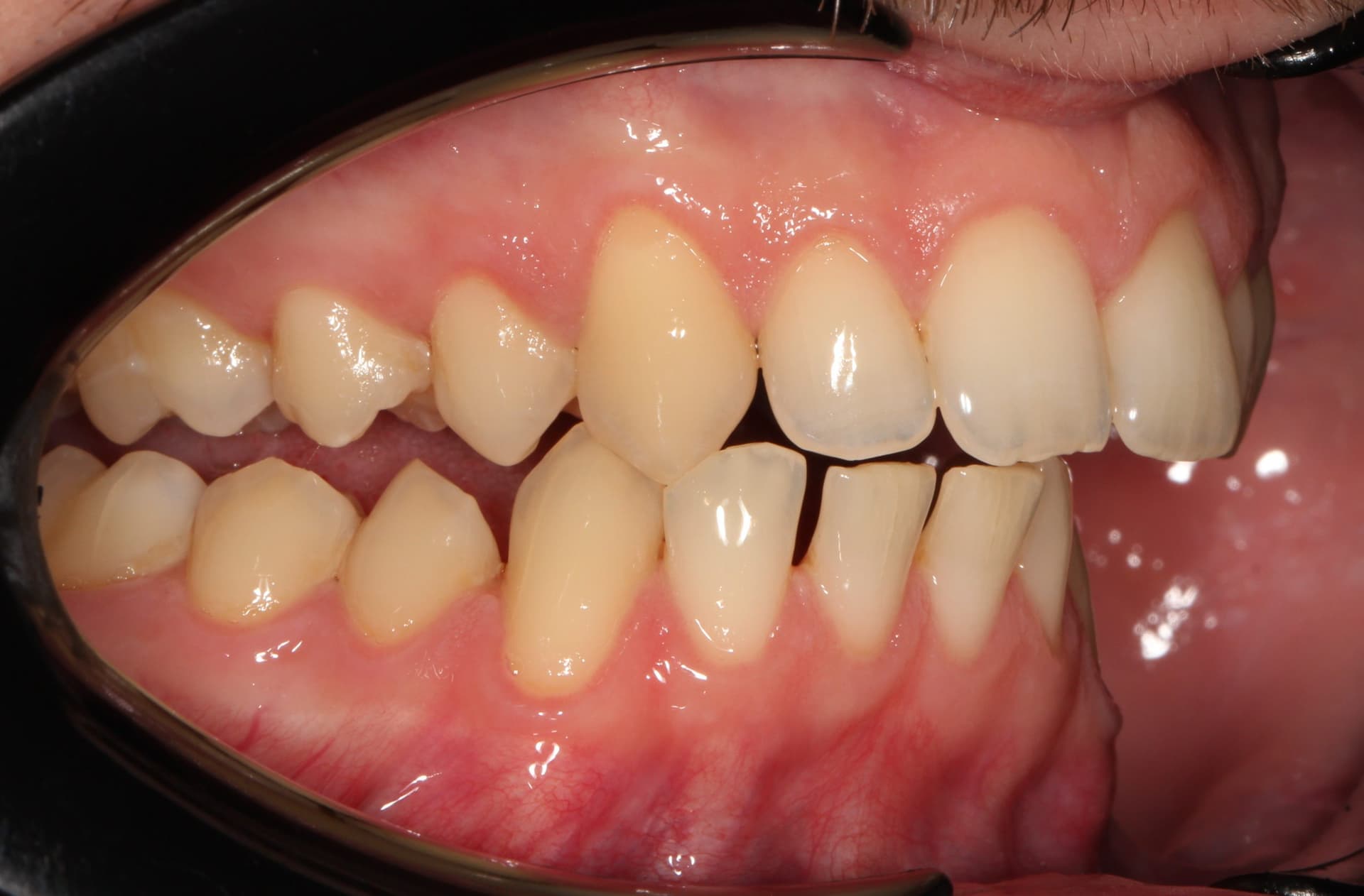 До фиксации брекет системой