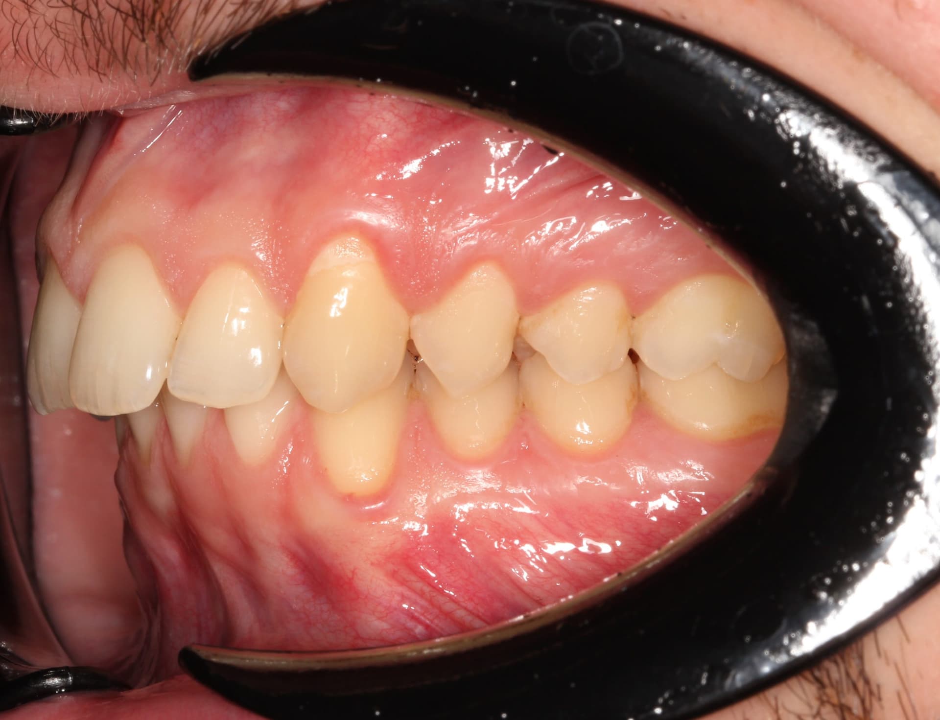 До фиксации брекет системой