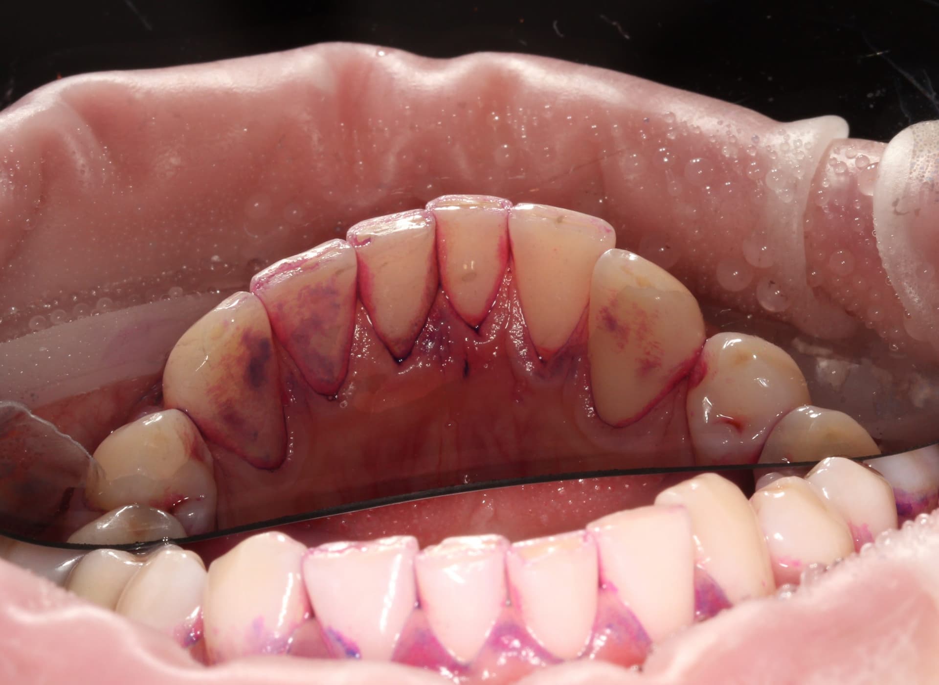 Окрашивание налета