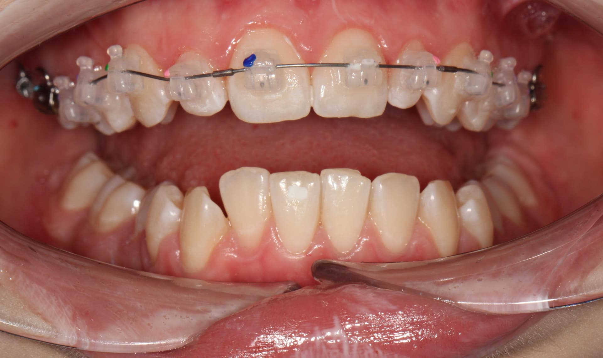 Фиксация брекет системы