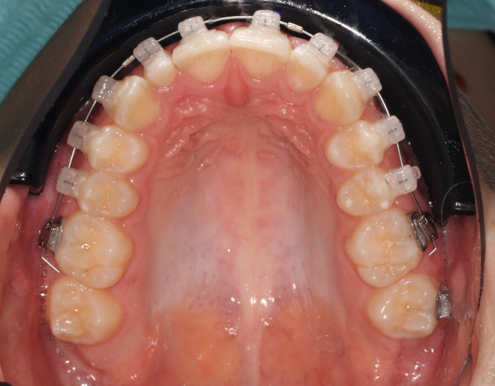 Фиксация брекет системы