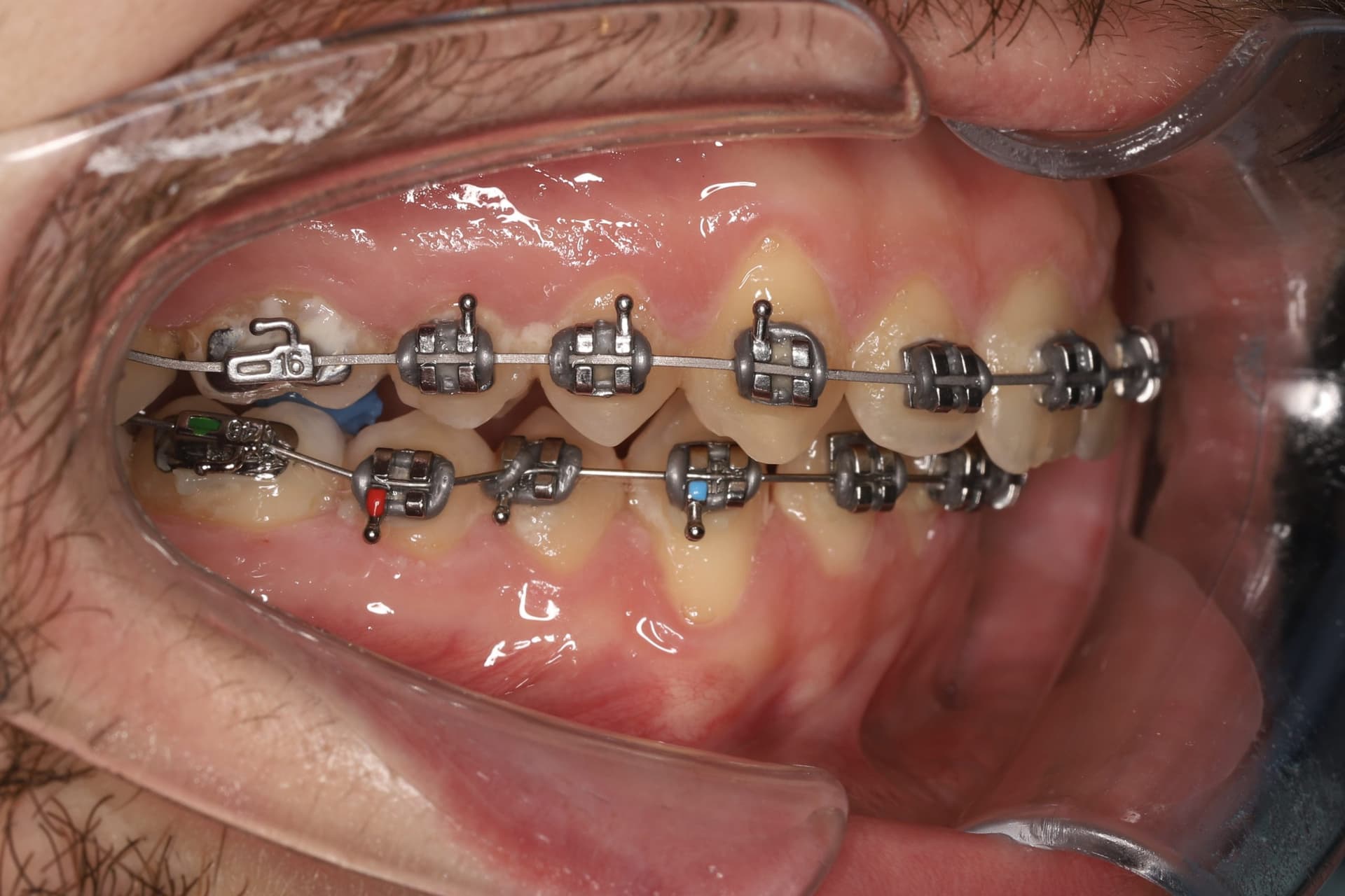 На этапе лечения