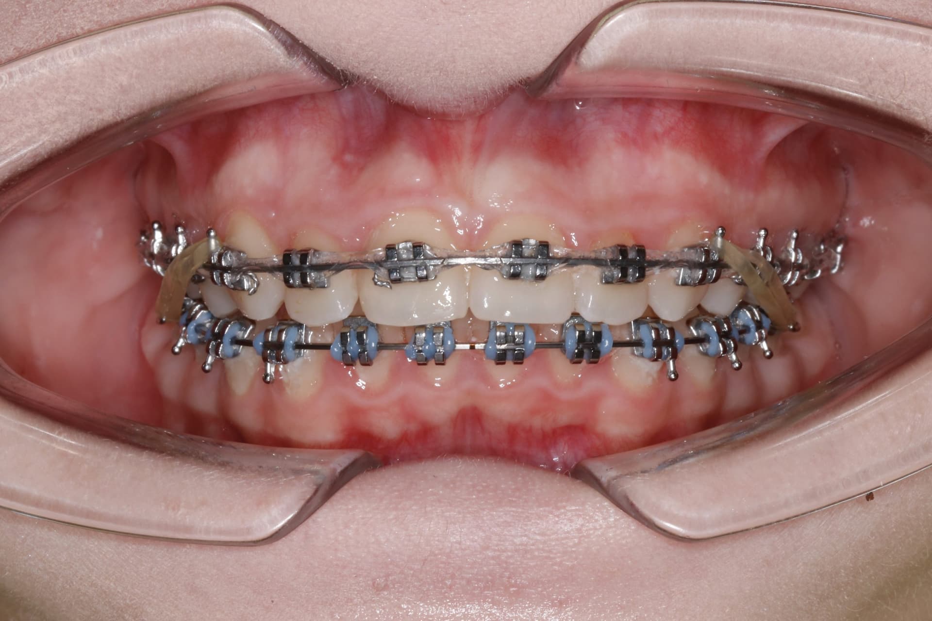 На этапе лечения 