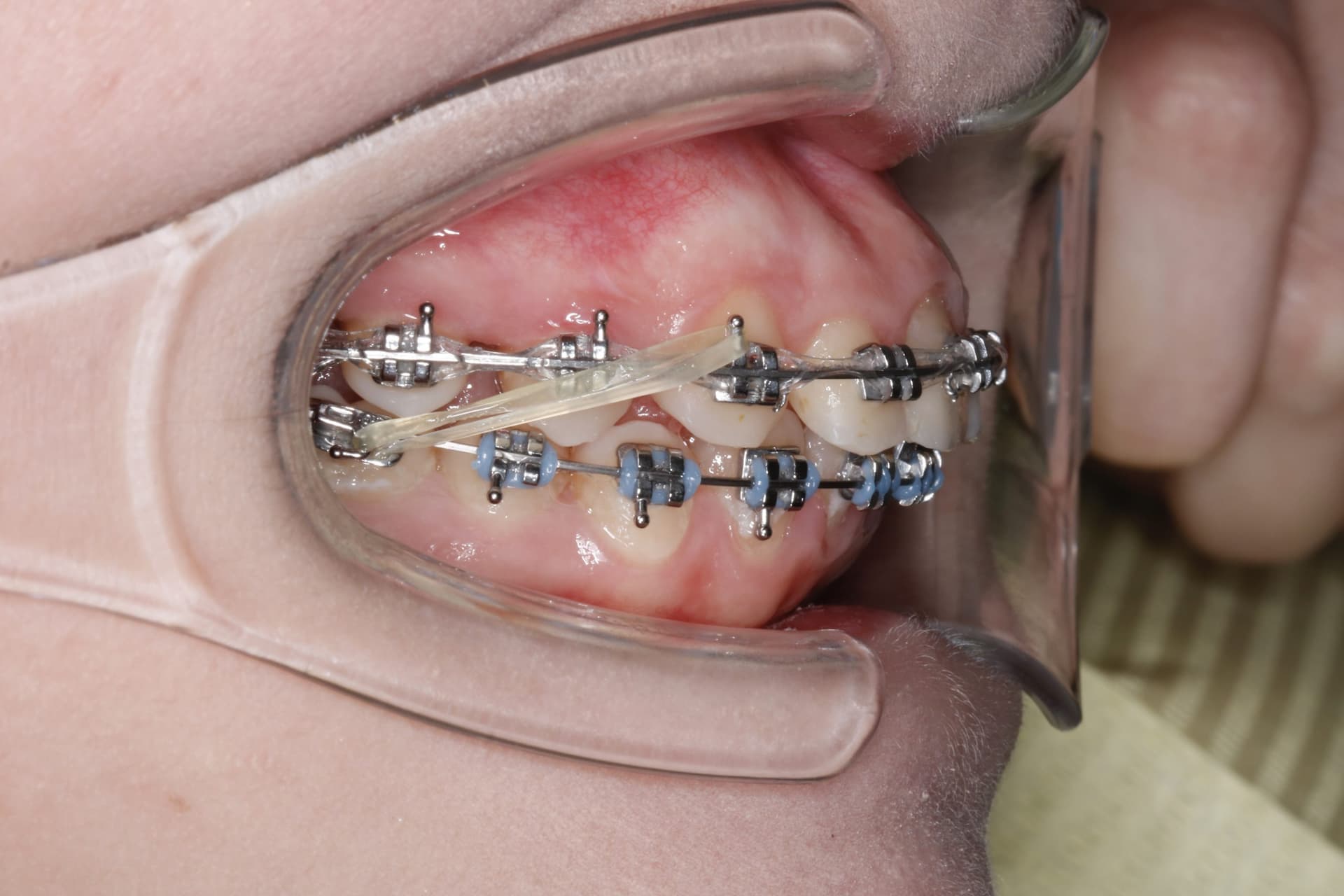 На этапе лечения 