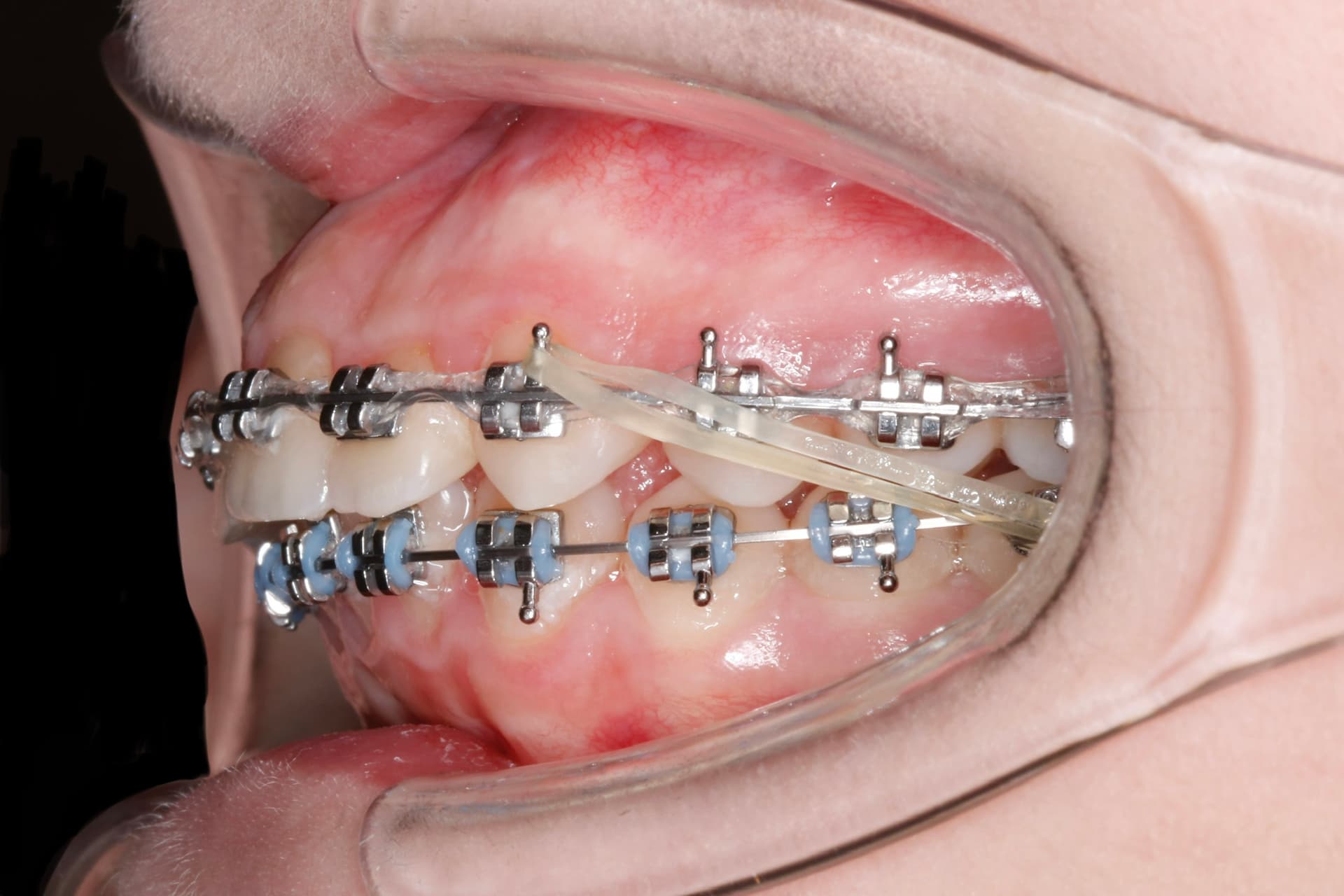 На этапе лечения 