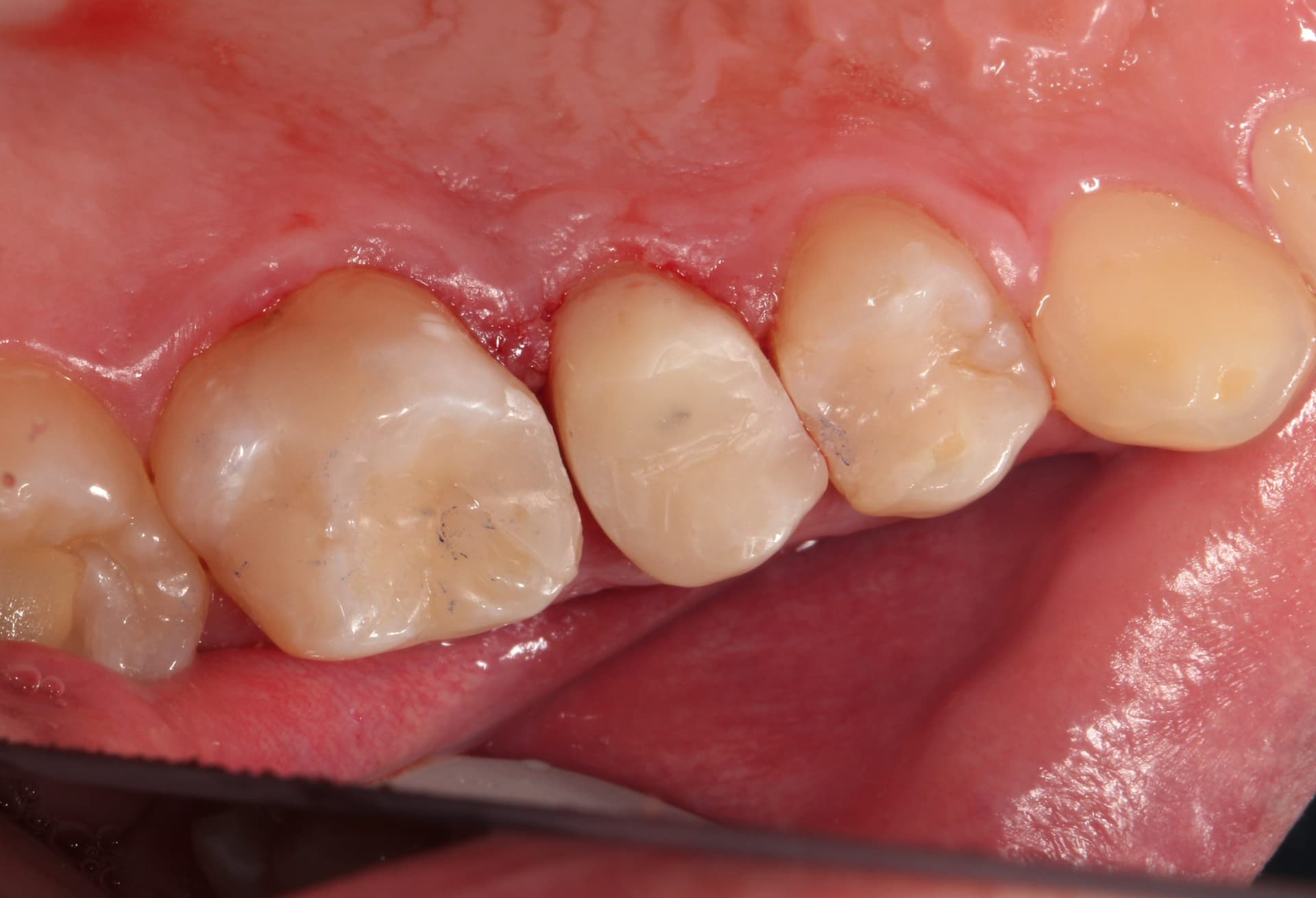 Билдап, а далее под коронку